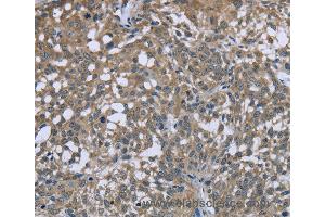 Immunohistochemistry of Human cervical cancer using PTK2B Polyclonal Antibody at dilution of 1:50