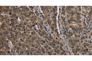 Immunohistochemistry of paraffin-embedded Human liver cancer using HIST1H2AH Polyclonal Antibody at dilution of 1:40