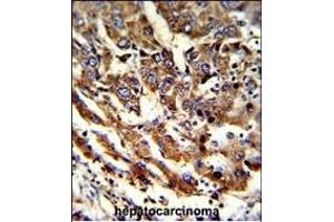 Formalin-fixed and paraffin-embedded human hepatocarcinoma reacted with ERP29 Antibody (Center), which was peroxidase-conjugated to the secondary antibody, followed by DAB staining. (ERP29 anticorps  (AA 151-179))