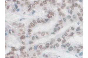 Detection of PCSK1 in Human Liver cancer Tissue using Polyclonal Antibody to Proprotein Convertase Subtilisin/Kexin Type 1 (PCSK1)