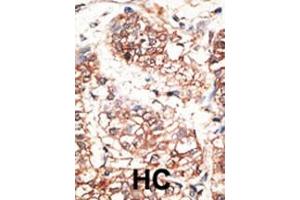 Formalin-fixed and paraffin-embedded human cancer tissue reacted with the primary antibody, which was peroxidase-conjugated to the secondary antibody, followed by AEC staining.