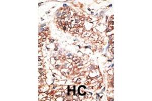 Formalin-fixed and paraffin-embedded human cancer tissue reacted with the primary antibody, which was peroxidase-conjugated to the secondary antibody, followed by AEC staining. (Neuregulin 3 anticorps  (AA 305-336))