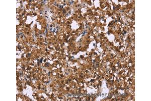 Immunohistochemistry of Human liver cancer using GPR171 Polyclonal Antibody at dilution of 1:40 (GPR171 anticorps)