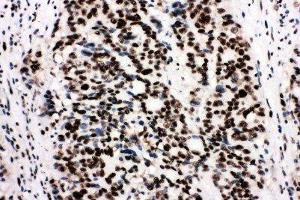 Anti-Ku80 antibody, IHC(P) IHC(P): Human Mammary Cancer Tissue (XRCC5 anticorps  (C-Term))