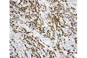 IHC-P: DCI antibody testing of human breast cancer tissue (DCI anticorps  (C-Term))