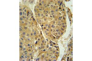 TUBB3 Antibody (N-term) (ABIN651938 and ABIN2840464) immunohistochemistry analysis in formalin fixed and paraffin embedded human hepatocarcinoma followed by peroxidase conjugation of the secondary antibody and DAB staining. (TUBB3 anticorps  (AA 36-63))