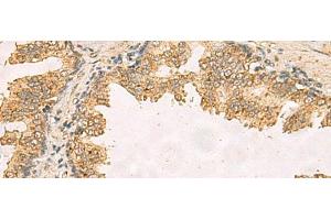 Immunohistochemistry of paraffin-embedded Human prost ate cancer tissue using RPS11 Polyclonal Antibody at dilution of 1:40(x200) (RPS11 anticorps)