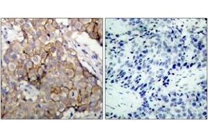 Immunohistochemistry analysis of paraffin-embedded human breast carcinoma tissue, using EGFR (Ab-1092) Antibody. (EGFR anticorps  (AA 1061-1110))
