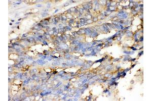 Anti- Cofilin Picoband antibody, IHC(P) IHC(P): Human Intestinal Cancer Tissue