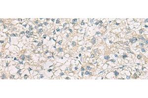 Immunohistochemistry of paraffin-embedded Human liver cancer tissue using CHMP6 Polyclonal Antibody at dilution of 1:65(x200)