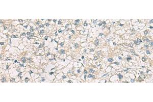 Immunohistochemistry of paraffin-embedded Human liver cancer tissue using CHMP6 Polyclonal Antibody at dilution of 1:65(x200) (CHMP6 anticorps)