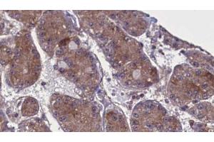 ABIN6277722 at 1/100 staining Human liver cancer tissue by IHC-P. (SPRY4 anticorps  (Internal Region))