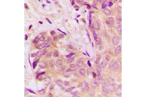 Immunohistochemical analysis of TGF beta 1 staining in human breast cancer formalin fixed paraffin embedded tissue section. (TGFB1 anticorps  (C-Term))