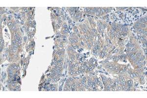 ABIN6276939 at 1/100 staining Human cervical cancer tissue by IHC-P. (EPXH2 anticorps)