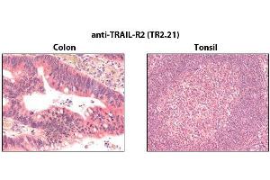 Immunohistochemistry detection of endogenous TRAIL-R2 in paraffin-embedded human carcinoma tissues (colon, tonsil) using mAb to TRAIL-R2 (TR2. (TNFRSF10B anticorps)
