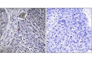 Immunohistochemistry analysis of paraffin-embedded human lung carcinoma tissue, using HNRPDL Antibody. (HNRPDL anticorps  (AA 241-290))