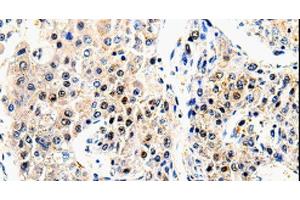 Immunohistochemistry of paraffin-embedded Human liver cancer using beta Amyloid Polyclonal Antibody at dilution of 1:100 (beta Amyloid anticorps)