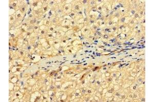 Immunohistochemistry of paraffin-embedded human liver cancer using ABIN7151164 at dilution of 1:100 (RNF182 anticorps  (AA 1-160))
