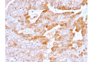 Formalin-fixed, paraffin-embedded human Renal Cell Carcinoma stained with CD137-Monospecific Mouse Monoclonal Antibody (4-1BB/3201).