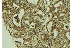 ABIN6273227 at 1/100 staining Human breast cancer tissue by IHC-P. (DIS3 anticorps  (Internal Region))