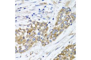 Immunohistochemistry of paraffin-embedded human colon carcinoma using PEX14 antibody. (PEX14 anticorps)