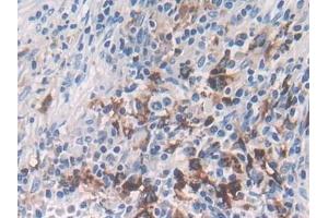 Detection of LRP4 in Human Lung cancer Tissue using Polyclonal Antibody to Low Density Lipoprotein Receptor Related Protein 4 (LRP4)