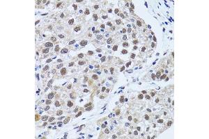Immunohistochemistry of paraffin-embedded human lung cancer using TP53BP1 antibody (ABIN5973380) at dilution of 1/100 (40x lens). (TP53BP1 anticorps)