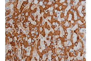 ABIN6256332 and ABIN6267233 at 1/200 staining human liver cancer tissue sections by IHC-P.