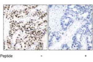 Immunohistochemical analysis of paraffin-embedded human breast carcinoma tissue using MYC polyclonal antibody  . (c-MYC anticorps)