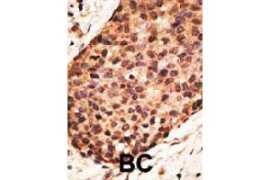 Formalin-fixed and paraffin-embedded human cancer tissue reacted with MMP16 polyclonal antibody  , which was peroxidase-conjugated to the secondary antibody, followed by AEC staining. (MMP16 anticorps  (N-Term))