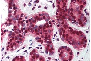 Human Breast (formalin-fixed, paraffin-embedded) stained with TP73 antibody ABIN290398 at 5 ug/ml followed by biotinylated goat anti-rabbit IgG secondary antibody ABIN481713, alkaline phosphatase-streptavidin and chromogen. (Tumor Protein p73 anticorps  (AA 75-125))
