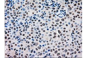 Immunohistochemical staining of paraffin-embedded Carcinoma of pancreas tissue using anti-MRI1mouse monoclonal antibody. (MRI1 anticorps)