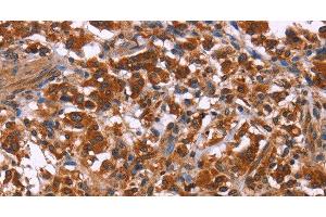 Immunohistochemistry of paraffin-embedded Human thyroid cancer using ING2 Polyclonal Antibody at dilution of 1:40