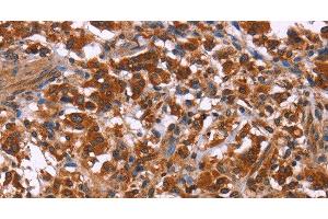Immunohistochemistry of paraffin-embedded Human thyroid cancer using ING2 Polyclonal Antibody at dilution of 1:40 (ING2 anticorps)