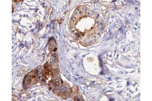 ABIN6266873 at 1/100 staining human Prostate cancer tissue sections by IHC-P. (STEAP4 anticorps  (C-Term))