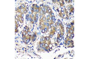 Immunohistochemistry of paraffin-embedded Human liver cancer using SEC23IP Rabbit pAb (ABIN7270170) at dilution of 1:100 (40x lens).