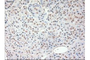 Immunohistochemical staining of paraffin-embedded Adenocarcinoma of ovary tissue using anti-SOX17 mouse monoclonal antibody. (SOX17 anticorps  (AA 177-414))