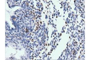 Immunohistochemical staining of paraffin-embedded Adenocarcinoma of Human endometrium tissue using anti-ARHGAP25 mouse monoclonal antibody. (ARHGAP25 anticorps)
