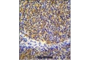 PSMB11 Antibody (C-term) (ABIN655286 and ABIN2844876) immunohistochemistry analysis in formalin fixed and paraffin embedded human thymoma followed by peroxidase conjugation of the secondary antibody and DAB staining. (PSMB11 anticorps  (C-Term))