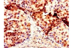 Immunohistochemistry of paraffin-embedded human breast cancer using ABIN7150637 at dilution of 1:100 (DMRT1 anticorps  (AA 195-363))