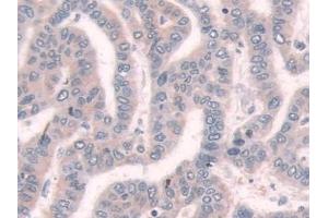 Detection of TPMT in Human Liver cancer Tissue using Polyclonal Antibody to Thiopurine Methyltransferase (TPMT)