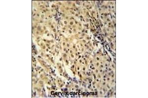 FOXC2 Antibody (Center ) (ABIN651936 and ABIN2840463) immunohistochemistry analysis in formalin fixed and paraffin embedded human cervix carcinoma followed by peroxidase conjugation of the secondary antibody and DAB staining. (FOXC2 anticorps  (AA 159-186))