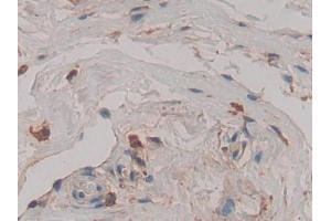 DAB staining on IHC-P; Samples: Human Breast cancer Tissue