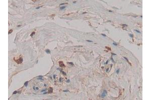 DAB staining on IHC-P; Samples: Human Breast cancer Tissue (Cathepsin D anticorps  (AA 169-408))