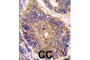 Formalin-fixed and paraffin-embedded human colon carcinoma tissue reacted with LDLRAP1 polyclonal antibody  , which was peroxidase-conjugated to the secondary antibody, followed by DAB staining. (LDLRAP1 anticorps  (N-Term))