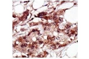 IHC analysis of FFPE human breast carcinoma tissue stained with the BRD4 antibody