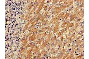 Immunohistochemistry of paraffin-embedded human liver cancer using ABIN7173558 at dilution of 1:100 (TPM3 anticorps  (AA 18-224))