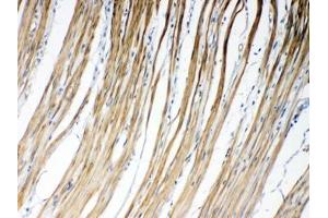 IHC testing of FFPE human intestinal cancer tissue with GJC1 antibody at 1ug/ml.