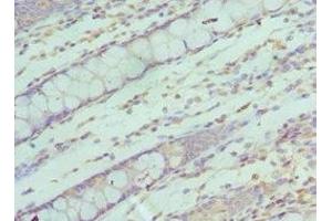 Immunohistochemistry of paraffin-embedded human colon cancer using ABIN7170622 at dilution of 1:100