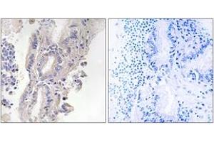 Immunohistochemistry analysis of paraffin-embedded human lung carcinoma, using PLCXD1 Antibody. (PLCXD1 anticorps  (AA 187-236))